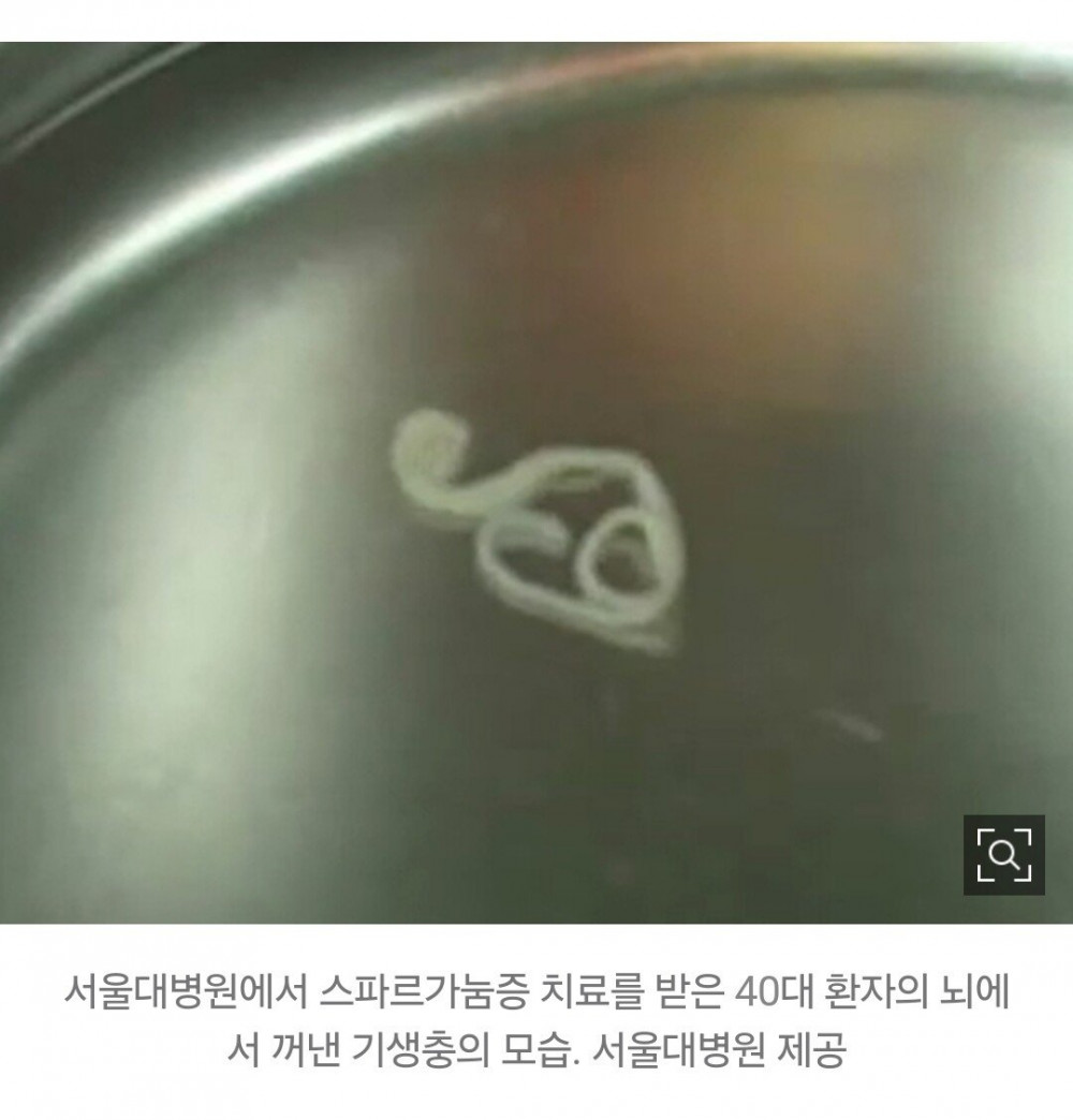 (약혐) 뇌 기생충 제거 영상 